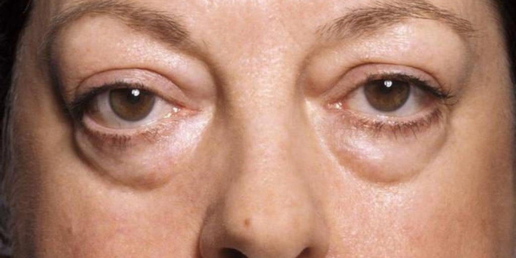 Почечные отеки начинаются с лица.