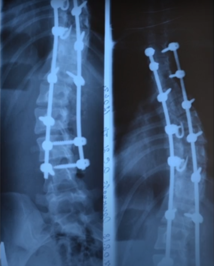 Уменьшение искривления до 30 градусов