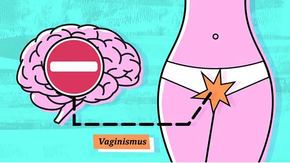 Первичный и вторичный вагинизм. Вагинизм симптомы причины. Вагинизм как проявляется. Половое воспитание вагинизм.