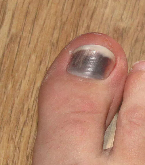 Грибок ногтей на ногах: симптомы, первые признаки, причины, как определить болезнь