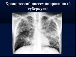 Какой врач лечит туберкулез