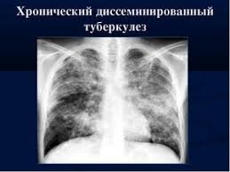 Хронизация заболевания протекает всегда на фоне ослабленного иммунитета. Микобактерии туберкулеза – возбудители заболевания – обладают высокой устойчивостью во внешней среде и в организме человека. Заразиться туберкулезом может каждый, как правило, инфицирование происходит воздушно-капельным путем, бациллы попадают в легкие и оседают там. Часть патогенных микроорганизмов подавляется иммунной системой человека сразу. Другие инкапсулируются и образуют так называемые туберкулы - туберкулезные гранулемы.