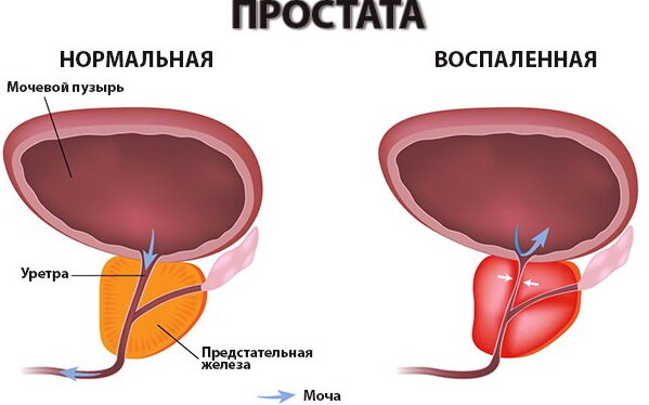 Почему у мужчины простатит