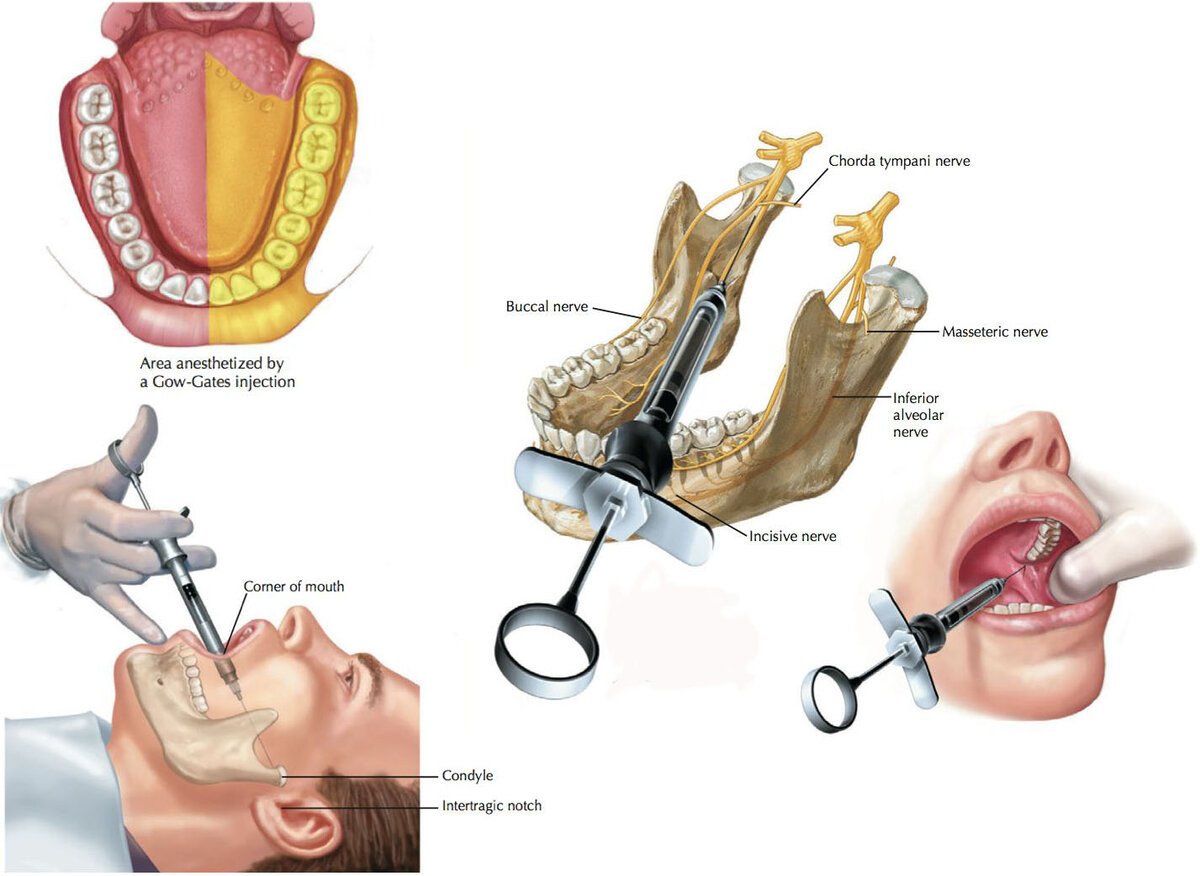Мандибулярная анестезия в стоматологии схема проведения видео