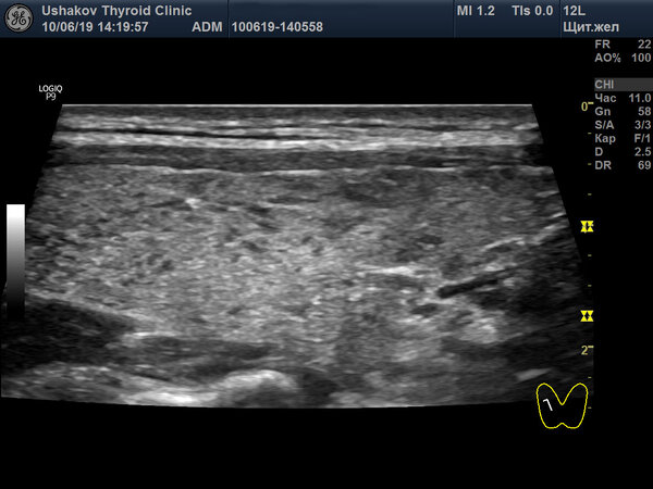 УЗИ щитовидной железы от 10.06.2019