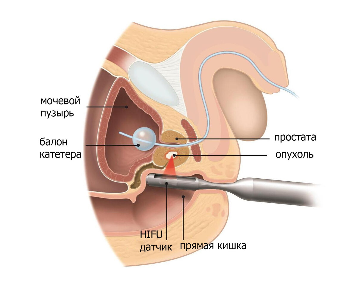 Влияние предстательной железы. HIFU терапия предстательной железы. Ультразвуковая абляция предстательной железы. Предстательная железа расположение. Расположение предстательной железы в организме мужчины.