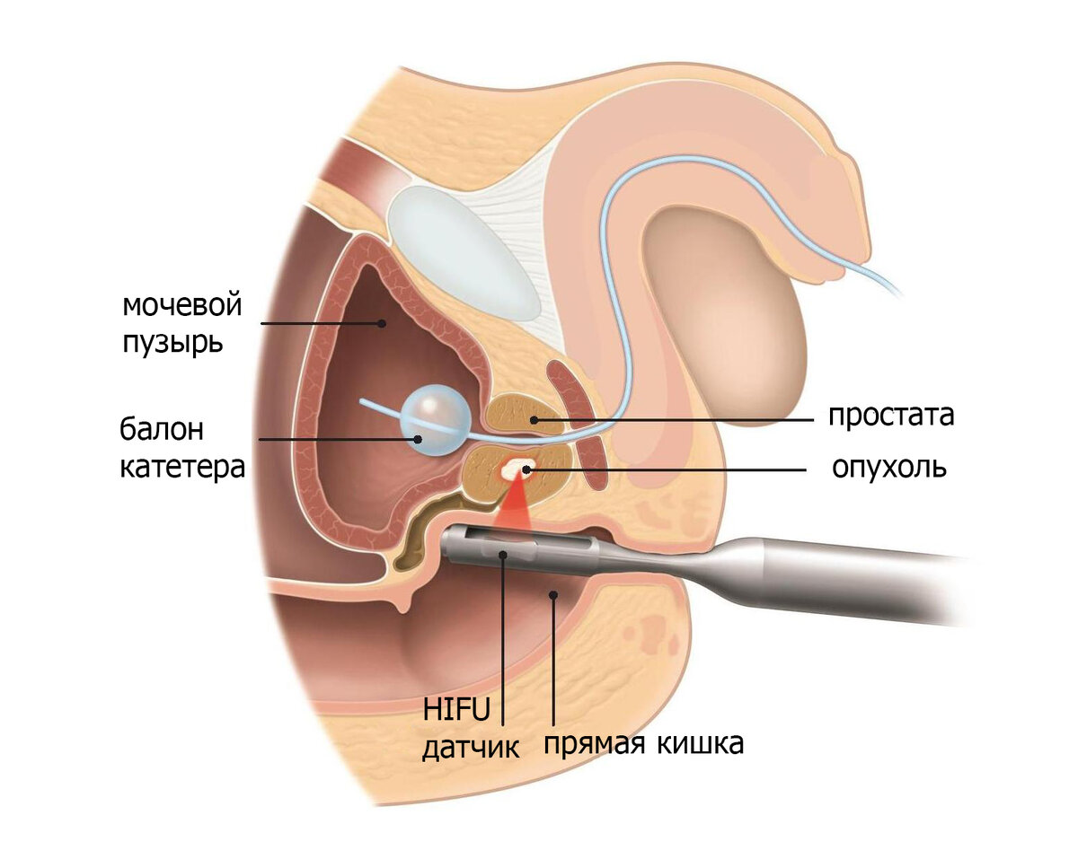 Уретра предстательной железы. HIFU терапия предстательной железы. Ультразвуковая абляция предстательной железы. Предстательная железа расположение. Расположение предстательной железы в организме мужчины.