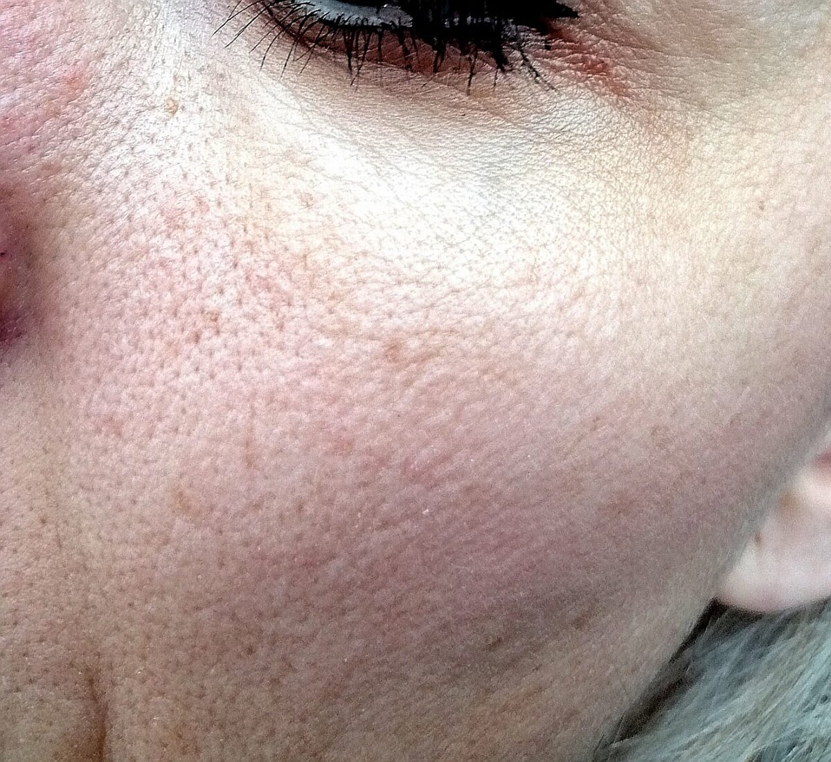 Лицо немного отошло, но темные пятна и дряблость после процедуры  остались