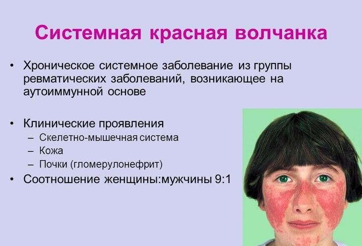 Как выглядит красная волчанка симптомы