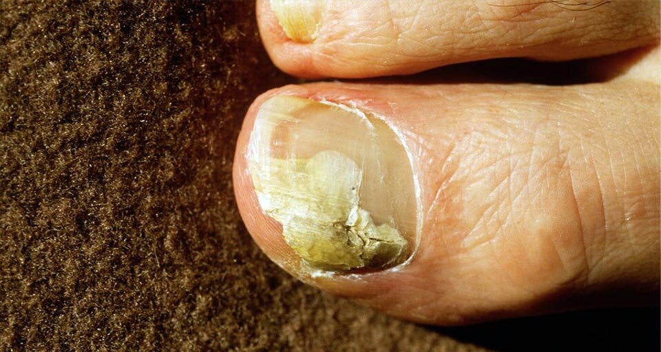  Появление пятен на ногтях ноги и рук может быть обусловлено разными причинами. Существует научное название белых пятен на ногтях рук и ног – лейконихия, но пятна могут быть не только белого цвета.-2