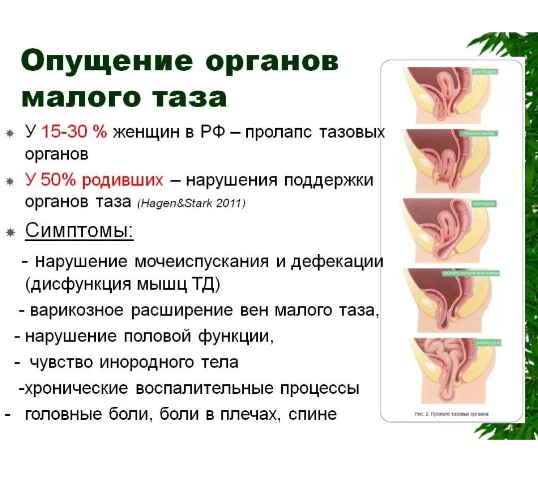 расширение вен таза