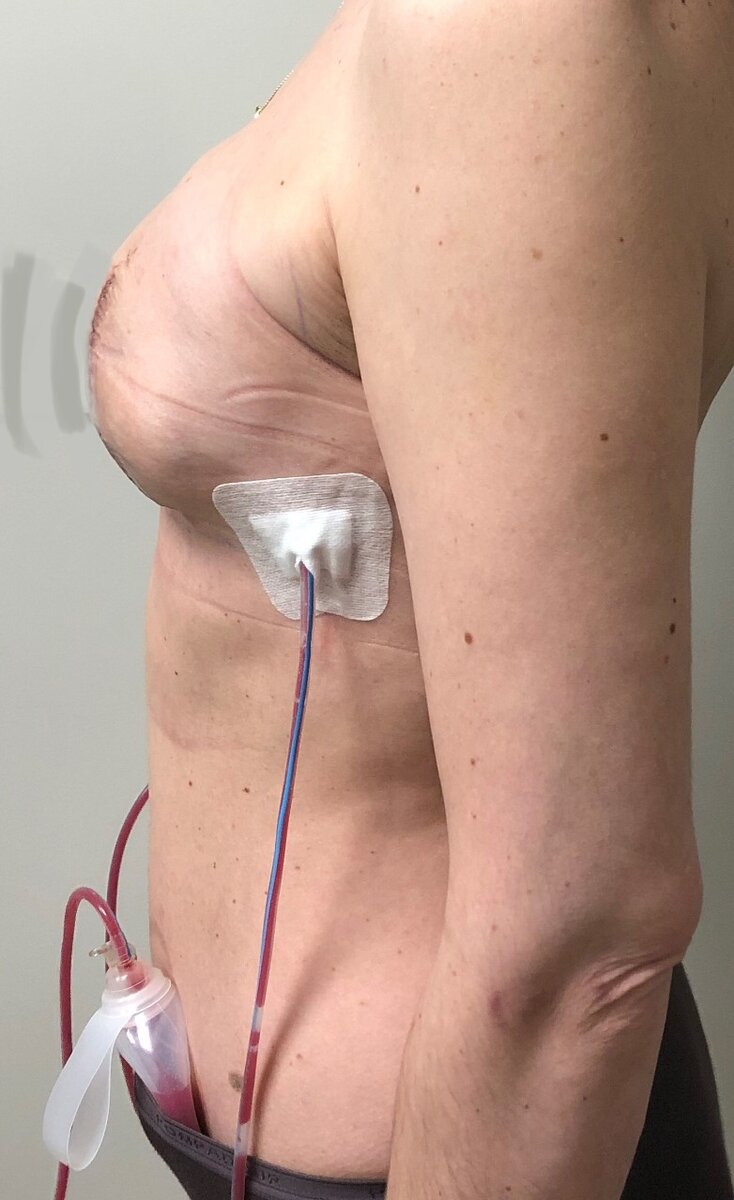 Жидкость в дренажных трубках окрашена кровью в красноватый цвет, это характерно для первых дней после операции