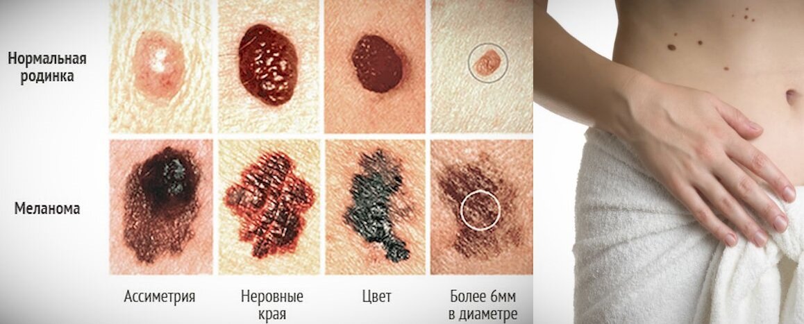 отличие обычной родинки и меланомы