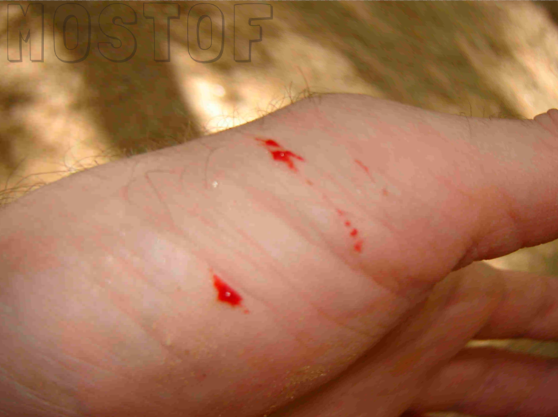 Следы от укуса