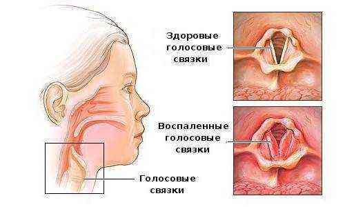 Аллергический фарингит