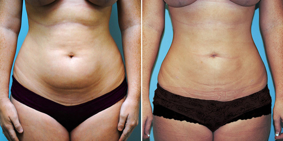 Липосакция является хирургической операцией, которая направлена на удаление излишков жира из различных частей тела. Не являются исключением бедра, ноги, колени, живот и подбородок.