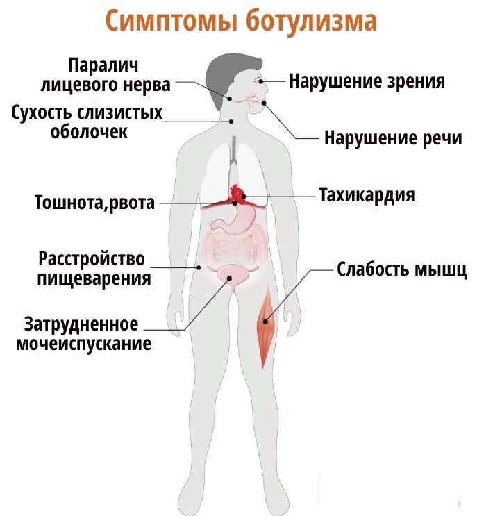 Какие признаки ботулизма