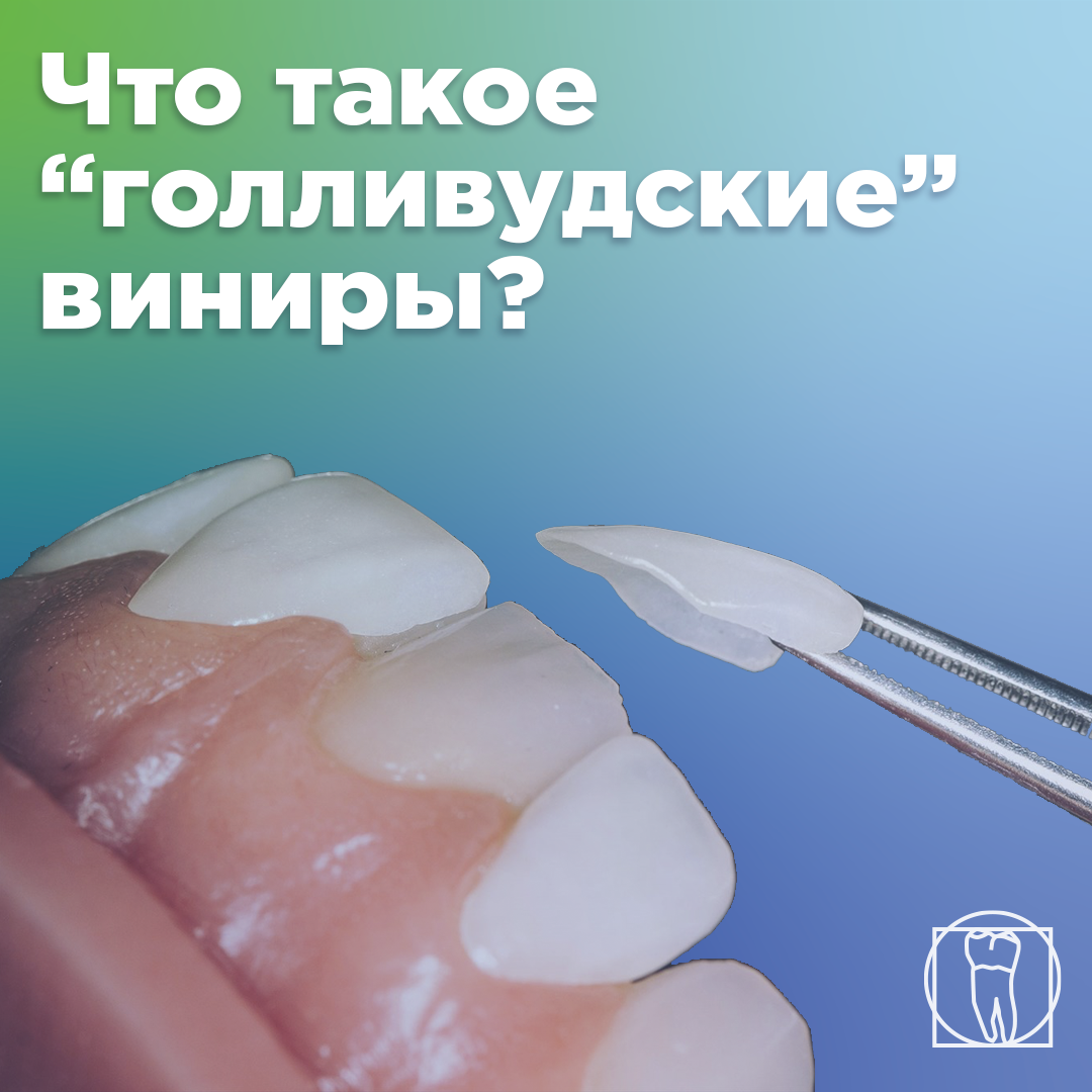 Прекрасное решение, чтобы скрыть недостатки передних зубов - это "голливудские виниры". Copyright © «СтомАртСтудио».