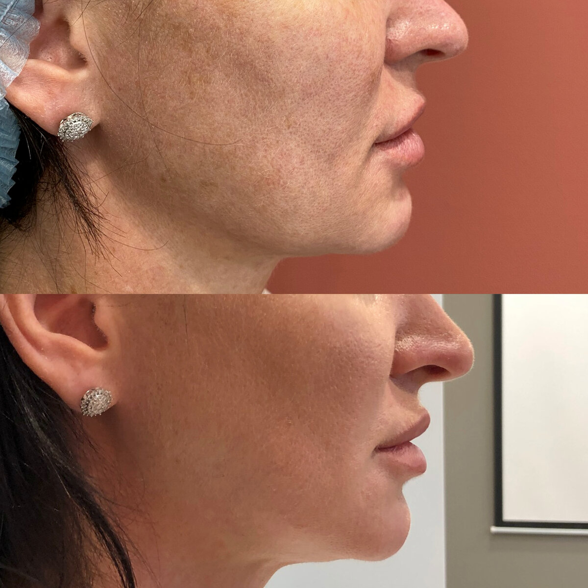 Альтера терапия овала лица