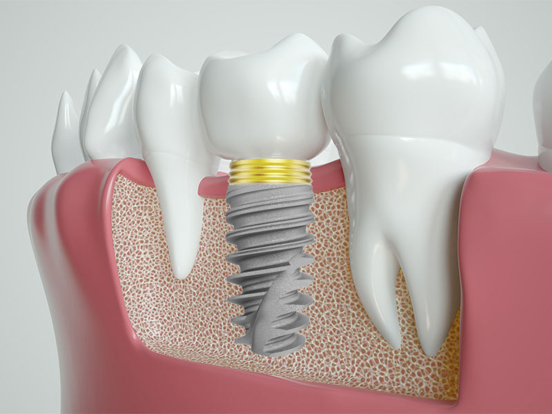 Имплант с циркониевой коронкой «под ключ» в Москве 55 000 руб.