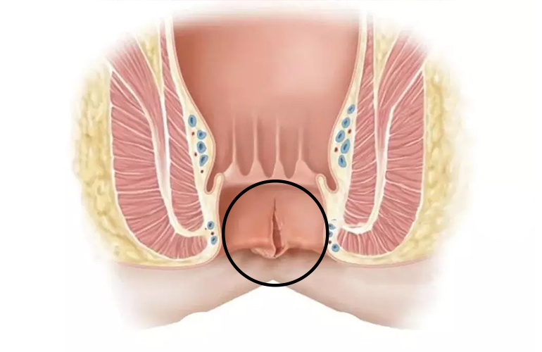 Анальная трещина