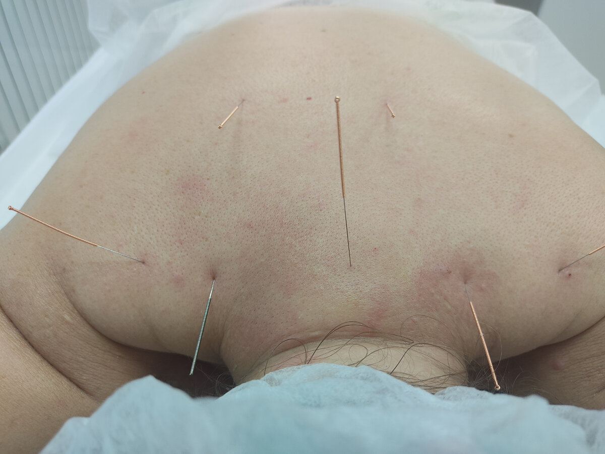 Сеанс иглоукалывания по методу ТКМ