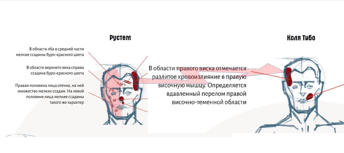 Боль в правом виске отдающая