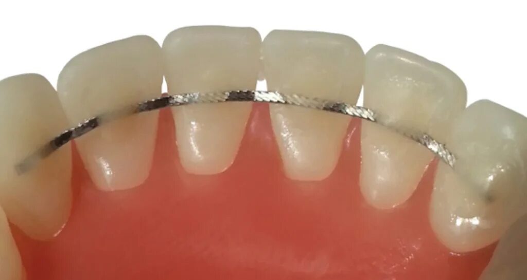 Ретейнер на зубах 