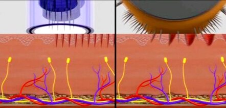 Проколы дермапеном и мезороллером