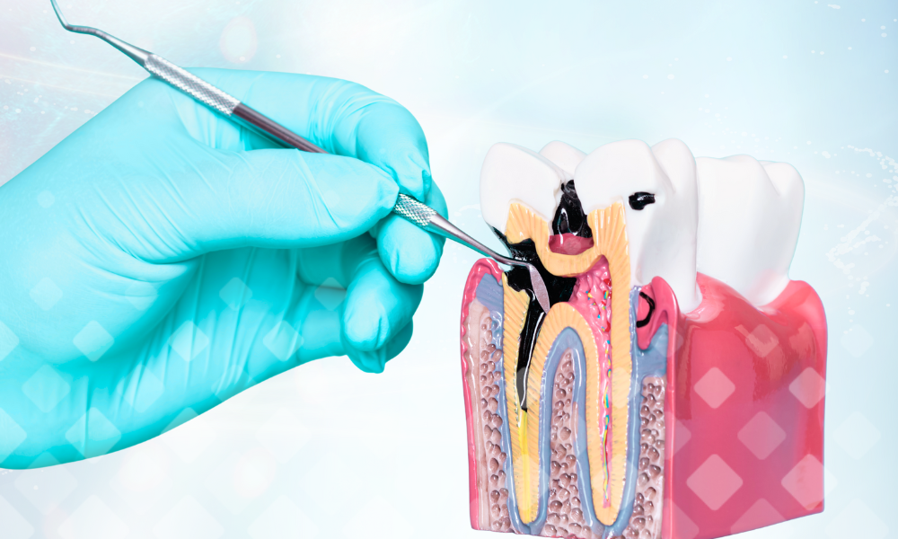 Так выглядит кариес, который поражает зуб сбоку – на картинке он затрагивает шейку (пришеечный кариес) и даже корень зуба (такое воспаление так и называют – кариес корня зуба).