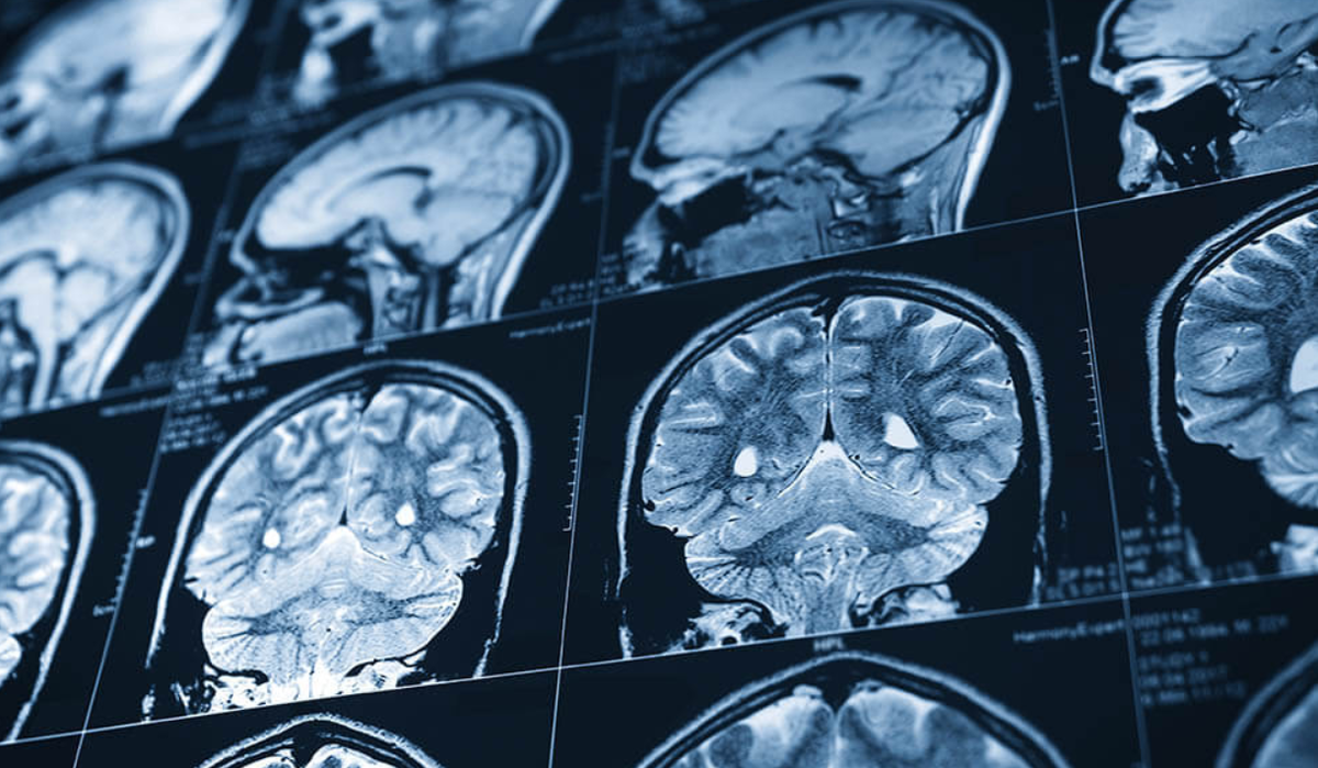 Почему повторяется инсульт?