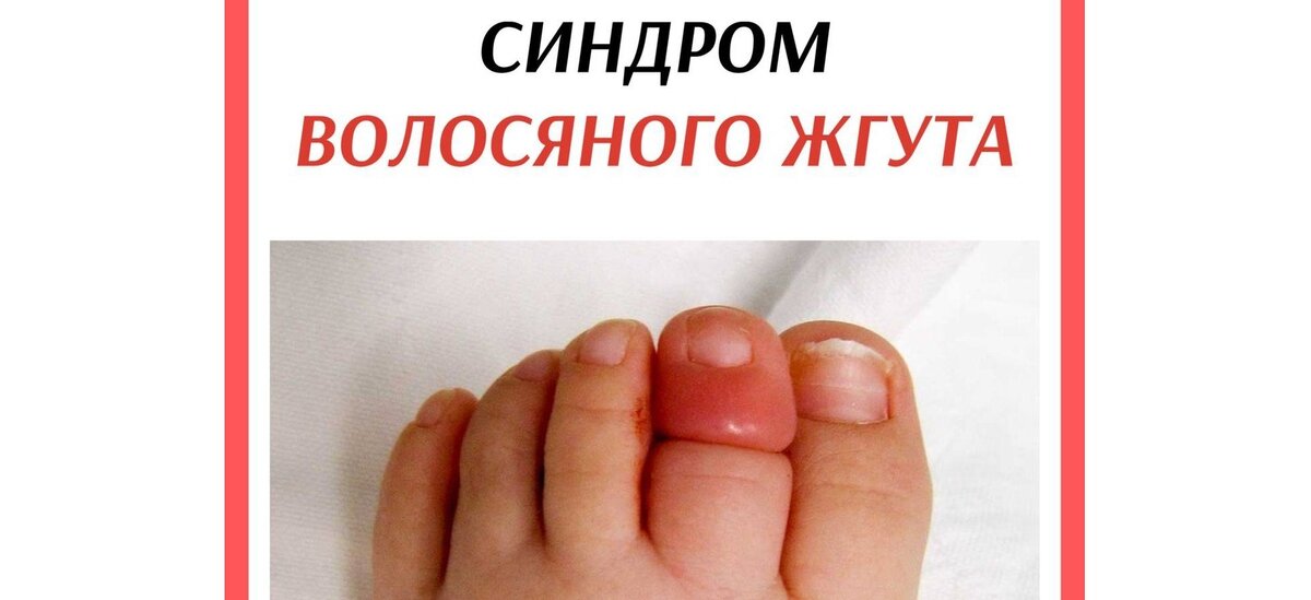 Синдром волосяного жгута у детей. Синдром волосяного жгута у грудничка. Симптом волосяного жгута. Волосяной жгут у младенца.