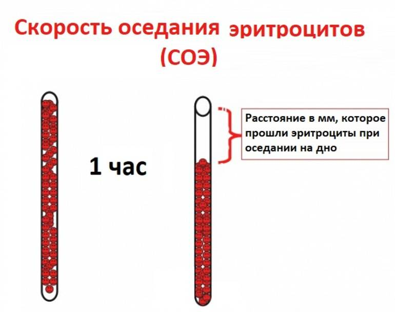 Механизм увеличения СОЭ. СОЭ метод Панченкова норма. Метод определения скорости оседания эритроцитов (СОЭ) по Панченкову.. СОЭ принцип метода.