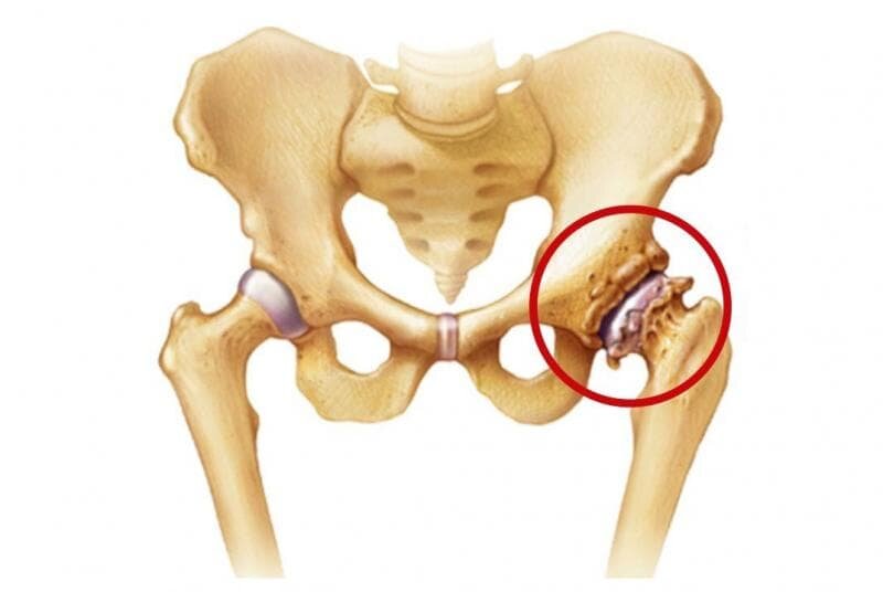 Симптомы коксартроза тазобедренного сустава. Коксартроз эндопротезирование тазобедренного сустава. Коксартроз тазобедренного после операции. Рентген снимок тазобедренного сустава после эндопротезирования. Эндопротез тазобедренного сустава.