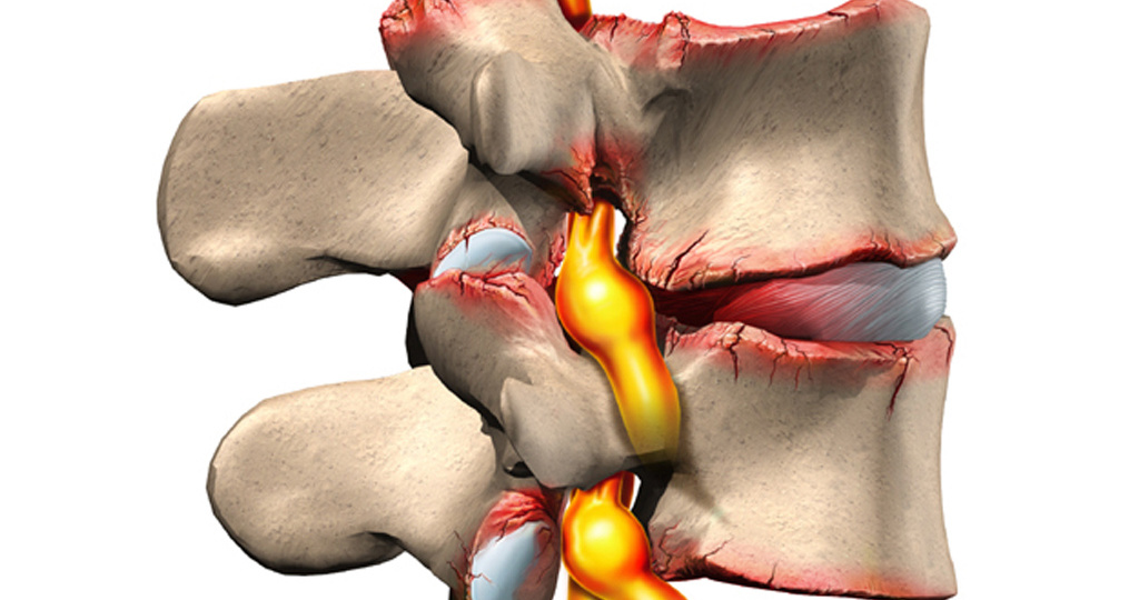 Спондилоартроз по распространенности не уступает остеохондрозу