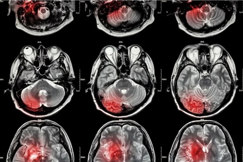 Видно ли инсульт на МРТ?