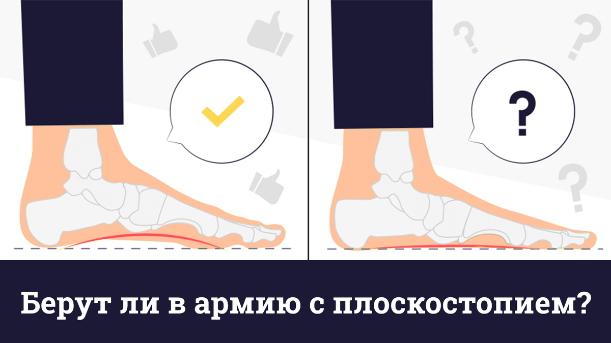 Берут ли сейчас с плоскостопием. Продольное плоскостопие 3. Плоскостопие 1 2 3 степени. 2 степень плоскостопия стопа. Плоскостопие 1 2 3 степени.
