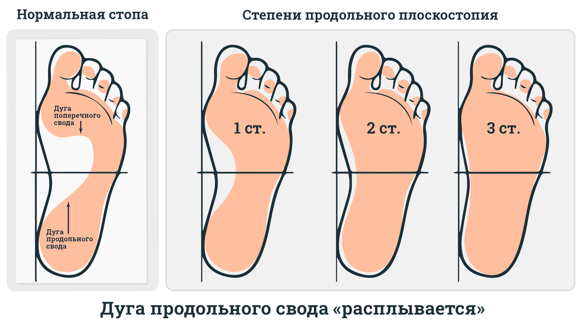 Берут ли 3 степенью плоскостопия. Продольное плоскостопие степени. С каким плоскостопием не берут. Продольное и поперечное плоскостопие.