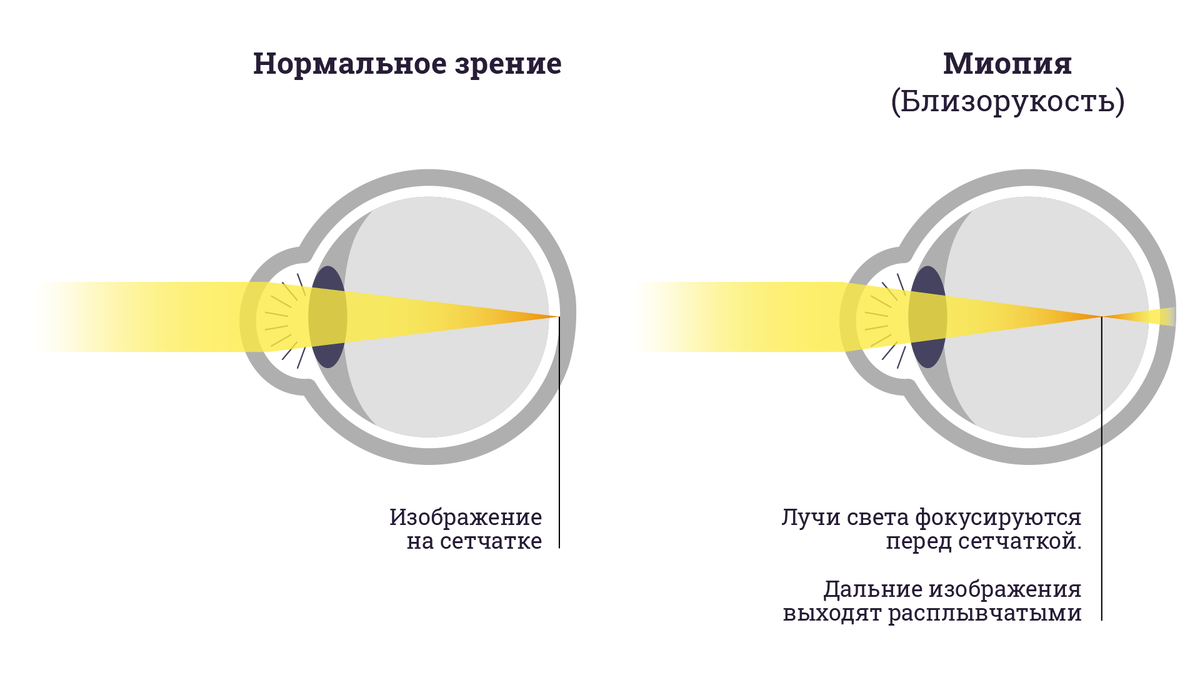 C каким зрением не берут в армию? | ПризываНет | Дзен
