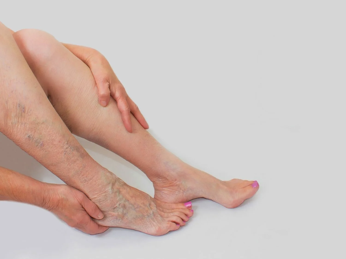 Правда о том, где еще, помимо ног, может "обосноваться" варикоз и как его распознать?