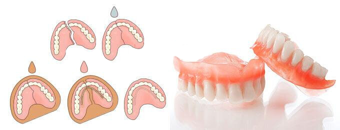 Перелом протеза. Починка съемных пластиночных протезов. Починка базиса частичного съемного пластиночного протеза. Поломанный съемный протез. Поломка съемного протеза.