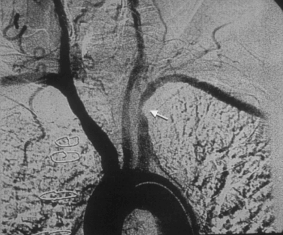 атеросклероз артерия брахиоцефальных артерий. окклюзия вса узи. стентирование подключичной артерии. стил-синдром подключичный узи. стеноз подключичной.