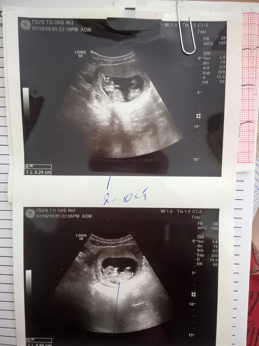 УЗИ с двойней на 11 неделе