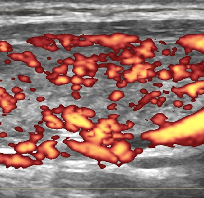 Перенапряжение щитовидной УЗИ 