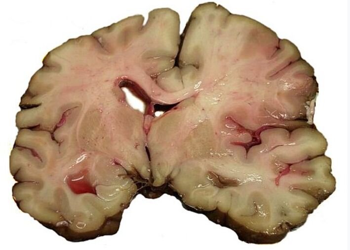 Срез мозга человека, умершего от инсульта.