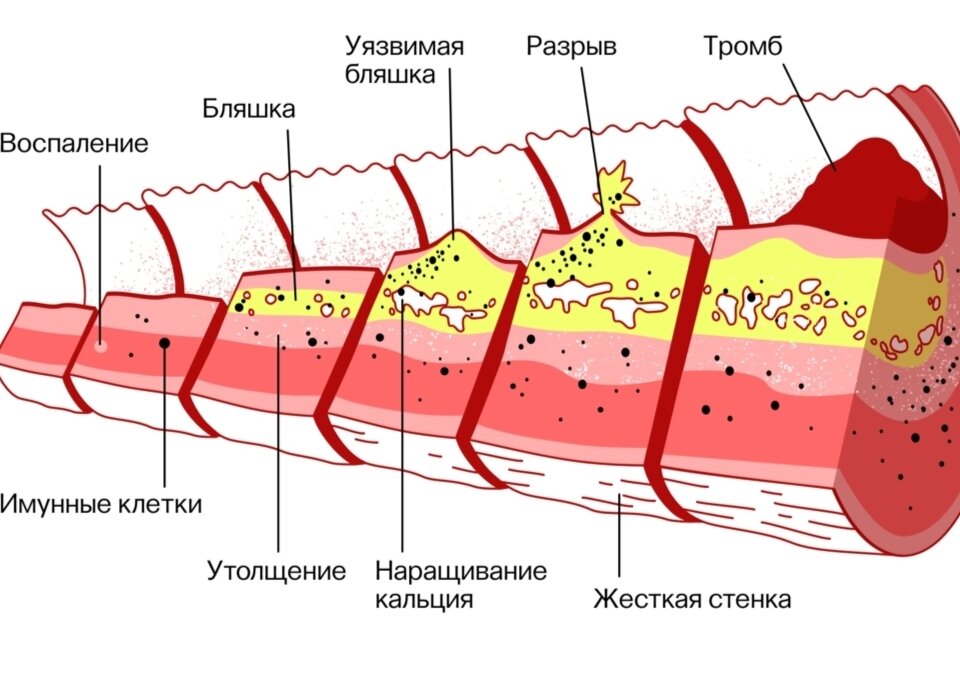 Холестериновые бляшки в сосудах шеи. Как очистить сосуды от холестериновых тромбов