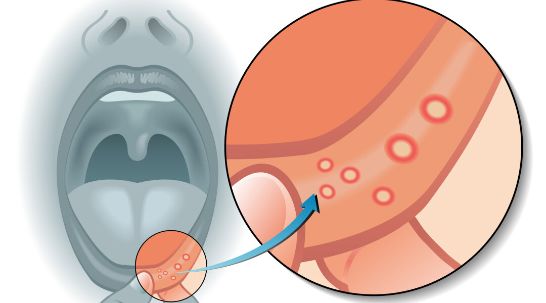 волдырь на внутренней стороне губы что это | Дзен