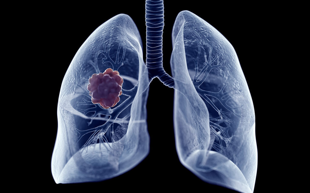 Новые клинические исследования дают надежду пациентам с немелкоклеточным раком легких