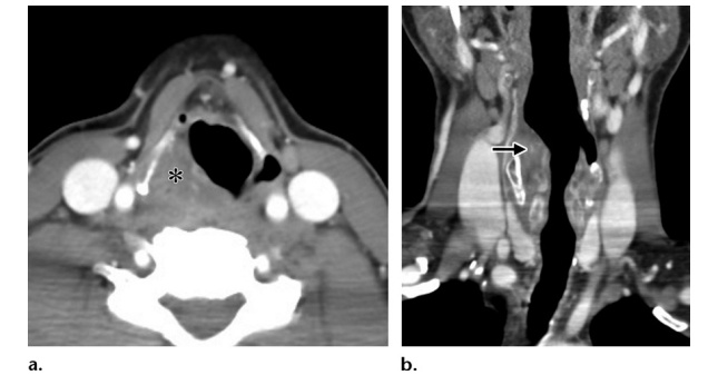 Рис 1. Надгортанная гематома у мужчины 25 лет с болью в шее после колющей травмы ручкой. Не было ни разрыва кожи, ни раневого канала инородного тела при осмотре, чтобы предположить проникающую травму. (а) На КТ в аксиальной плоскости видна правосторонняя надгортанная гематома со сглаживанием грушевидной пазухи (*). (b) На КТ в корональной плоскости видны деформация и сужение дыхательных путей из-за надгортанной гематомы (стрелка).