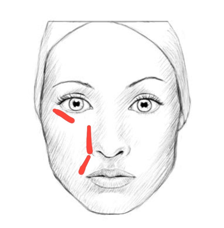 Схема образования заломов от неправильного положения во сне